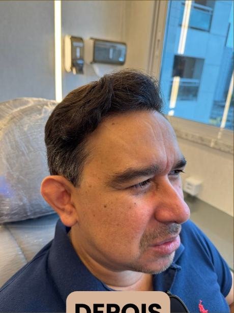 Depois do transplante capilar