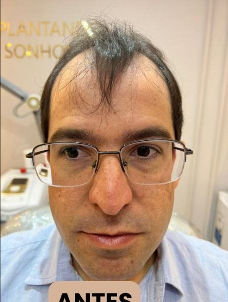 Antes do transplante capilar