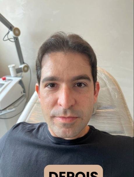 Depois do transplante capilar