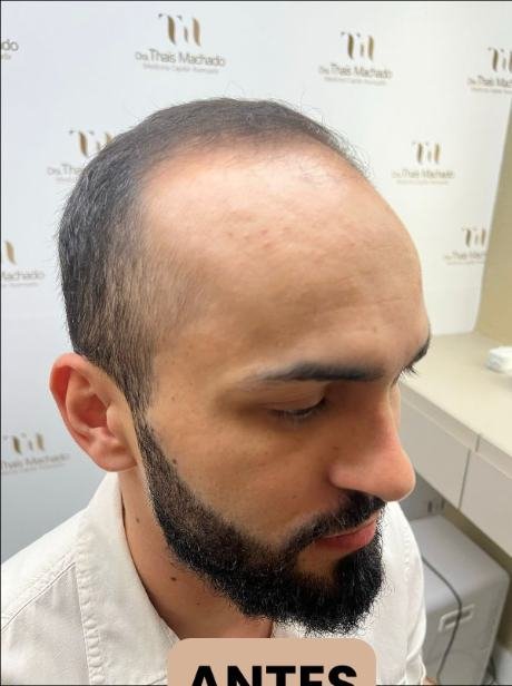 Antes do transplante capilar