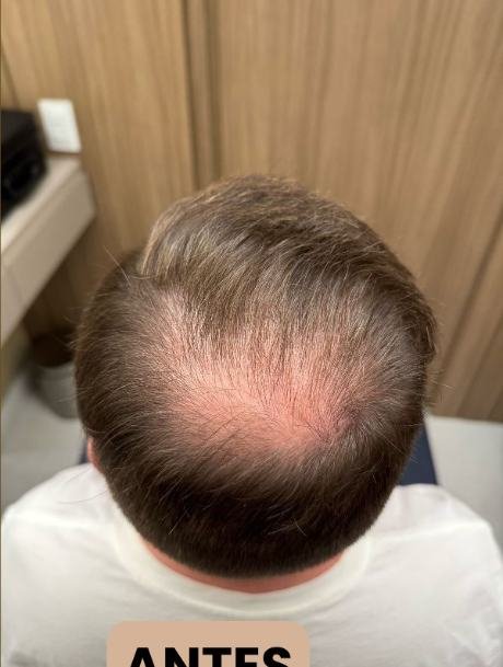 Antes do transplante capilar