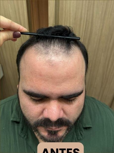 Antes do transplante capilar