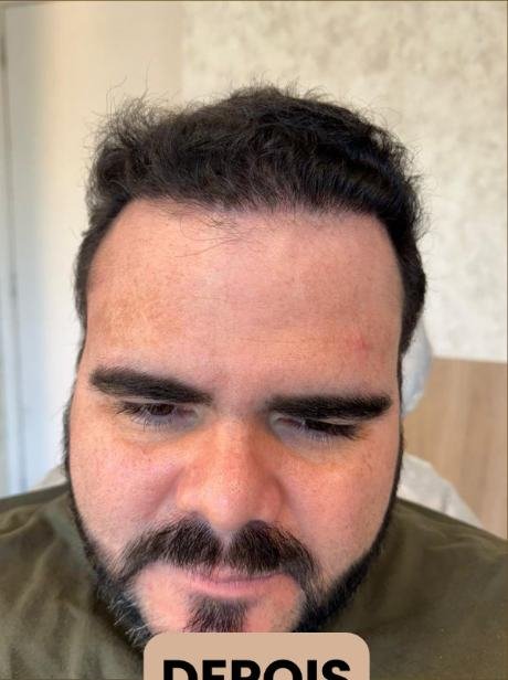 Depois do transplante capilar