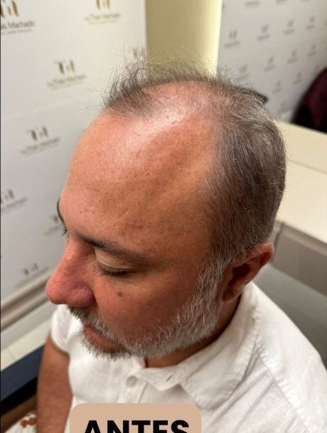 Antes do transplante capilar
