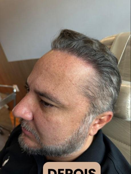 Depois do transplante capilar