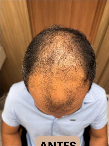 Antes do transplante capilar