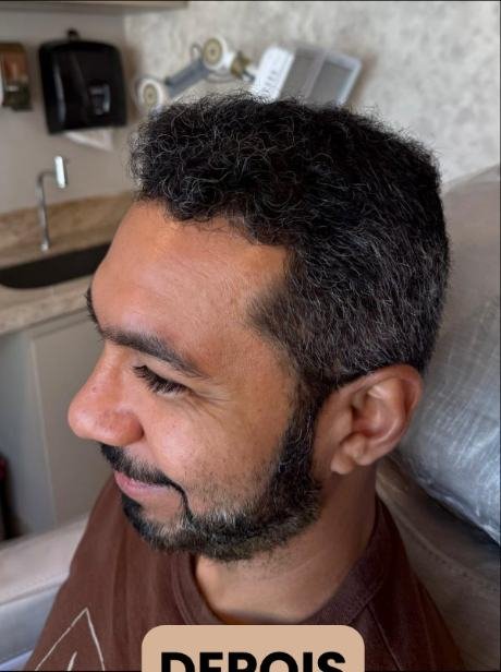 Depois do transplante capilar