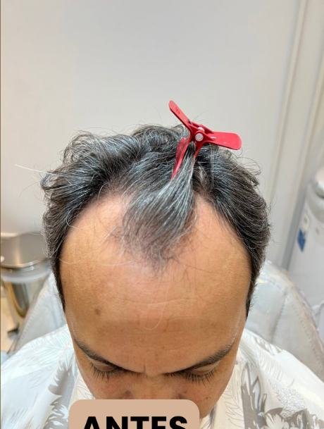 Antes do transplante capilar