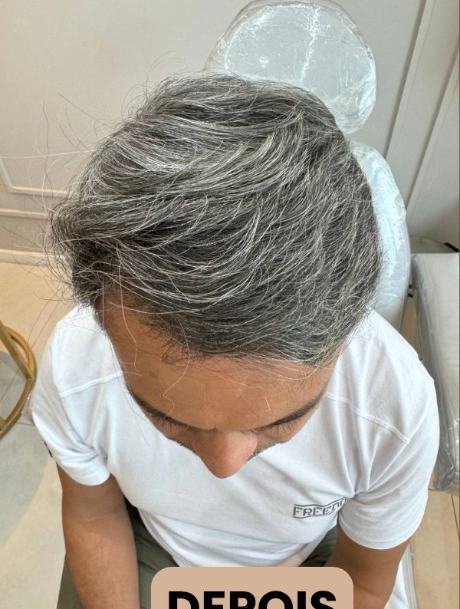 Depois do transplante capilar