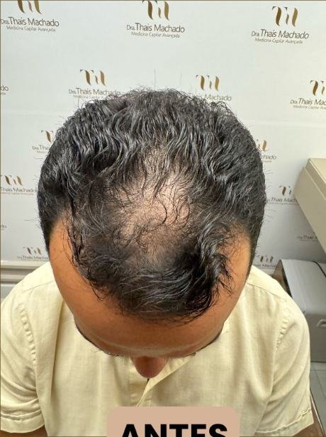 Antes do transplante capilar