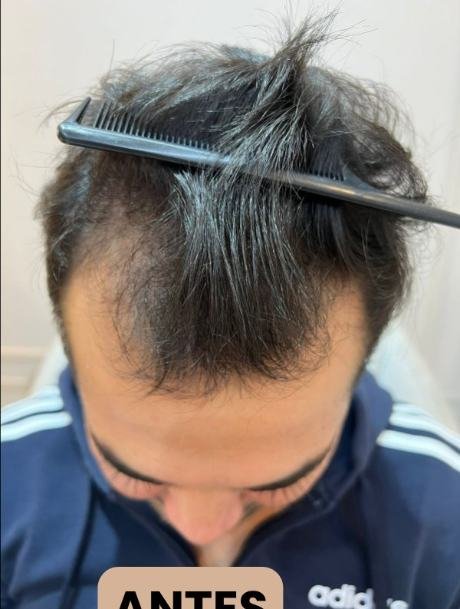 Antes do transplante capilar