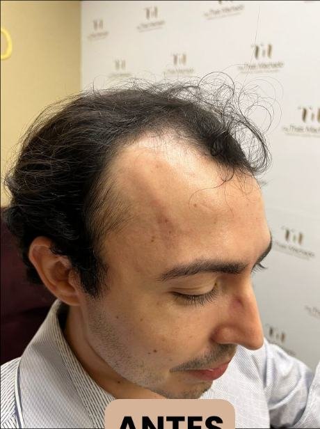 Antes do transplante capilar