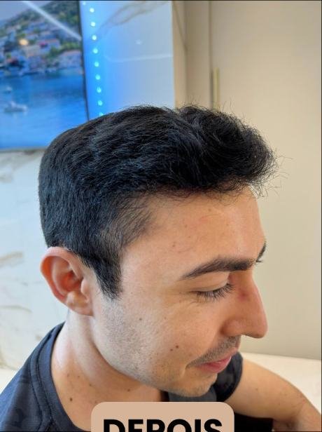 Depois do transplante capilar
