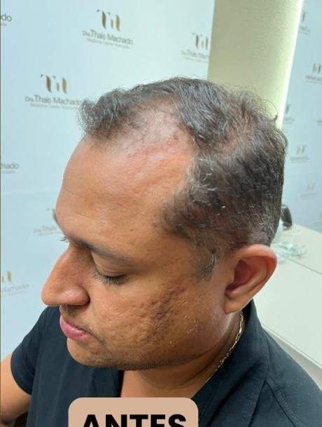 Antes do transplante capilar