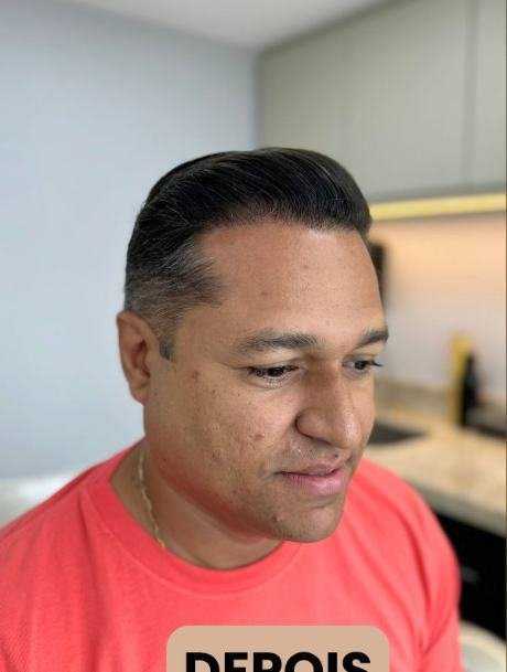 Depois do transplante capilar