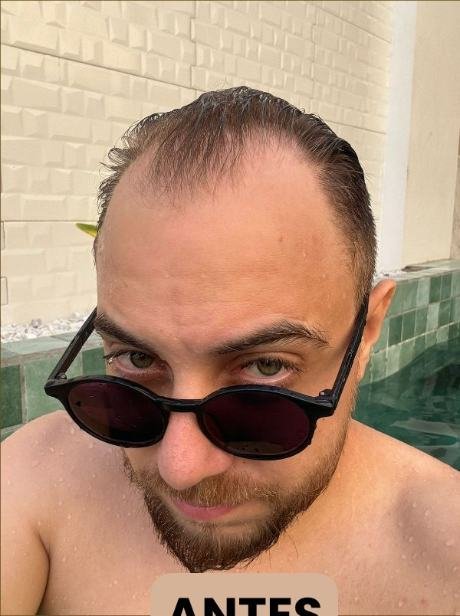 Antes do transplante capilar