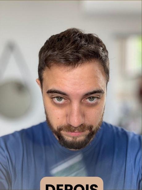Depois do transplante capilar