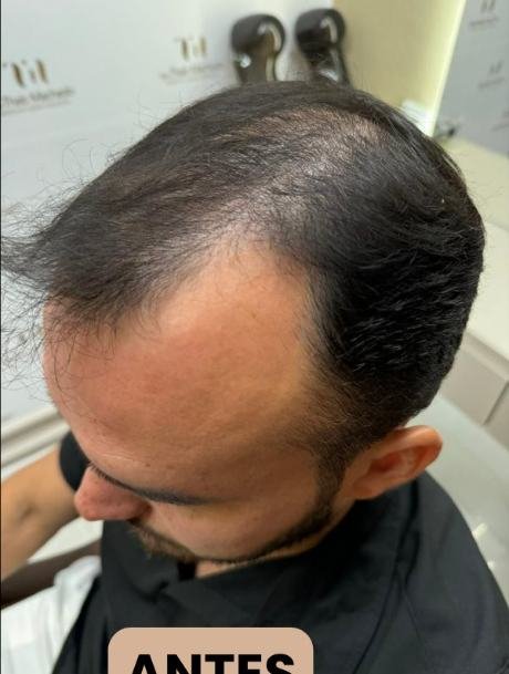 Antes do transplante capilar