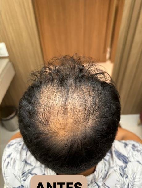 Antes do transplante capilar
