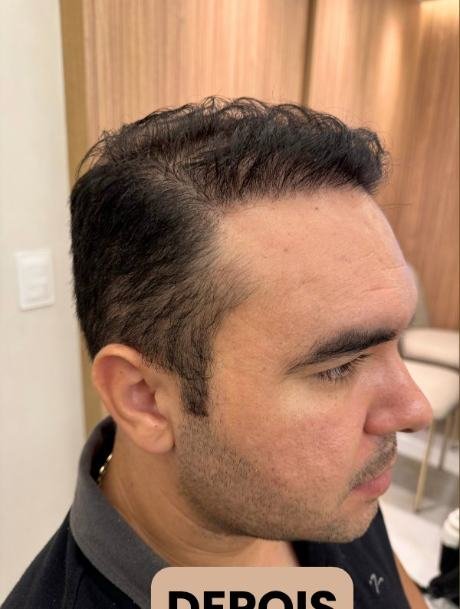 Depois do transplante capilar