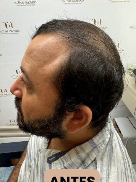 Antes do transplante capilar