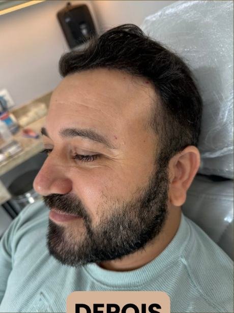 Depois do transplante capilar