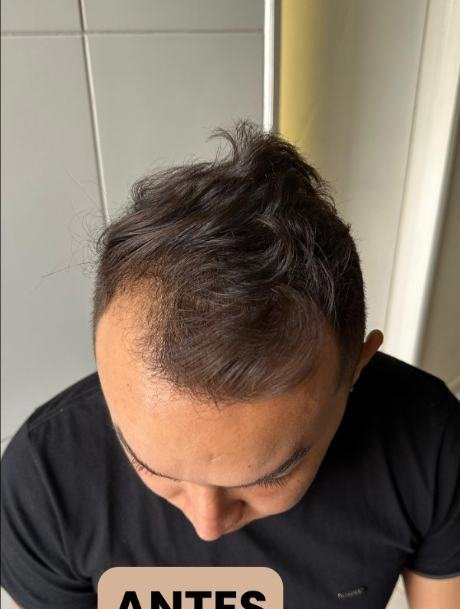 Antes do transplante capilar