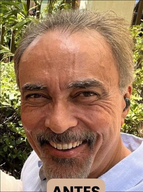 Antes do transplante capilar
