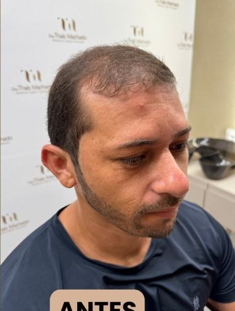 Antes do transplante capilar