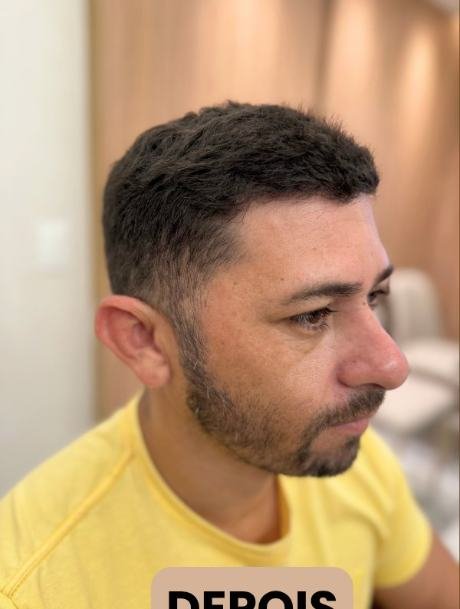 Depois do transplante capilar
