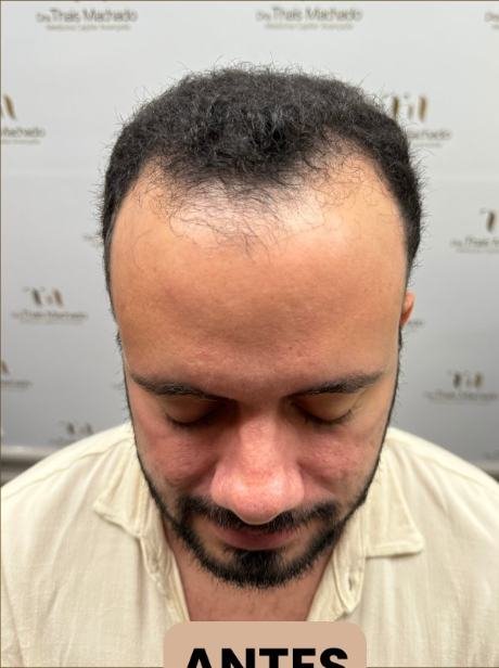 Antes do transplante capilar