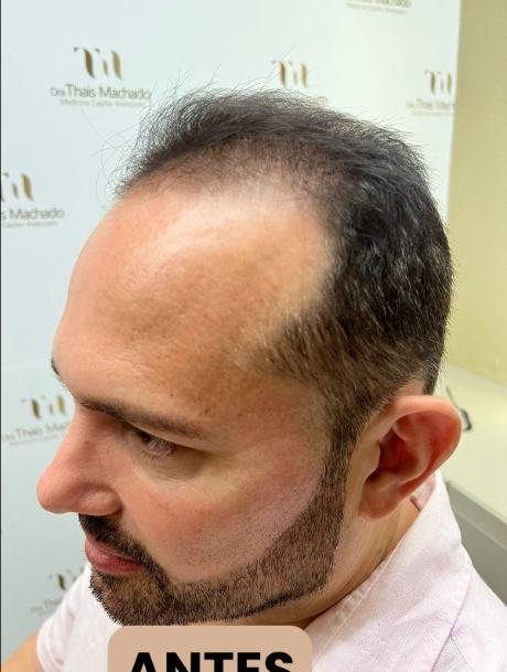 Antes do transplante capilar