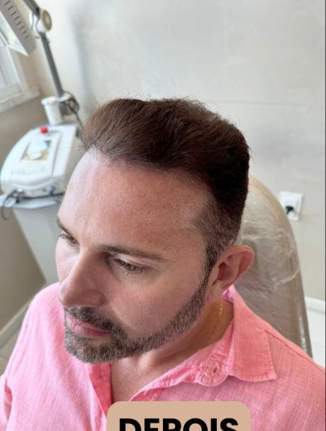 Depois do transplante capilar