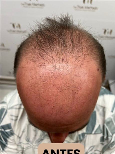 Antes do transplante capilar