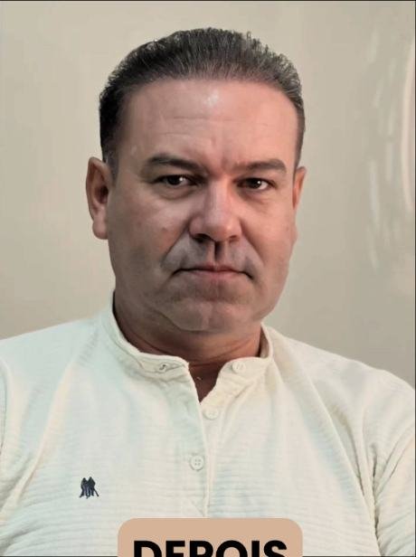 Depois do transplante capilar