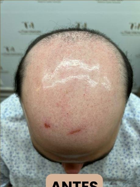 Antes do transplante capilar