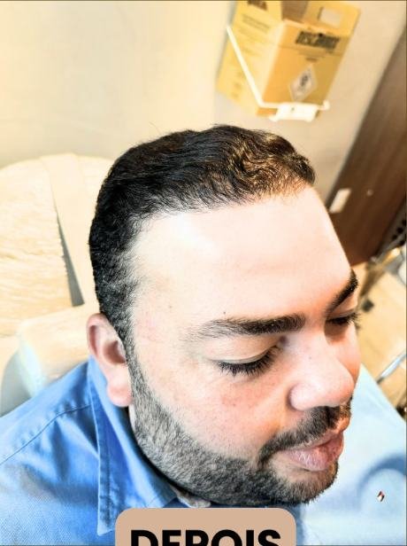 Depois do transplante capilar