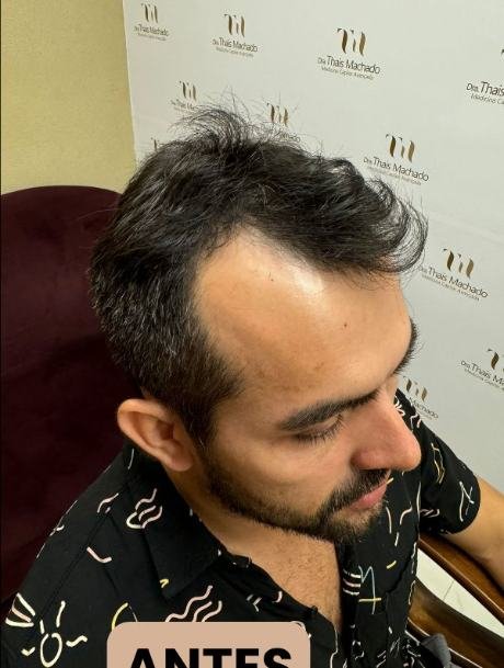 Antes do transplante capilar