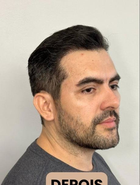 Depois do transplante capilar