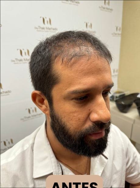 Antes do transplante capilar