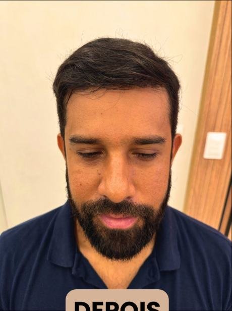 Depois do transplante capilar