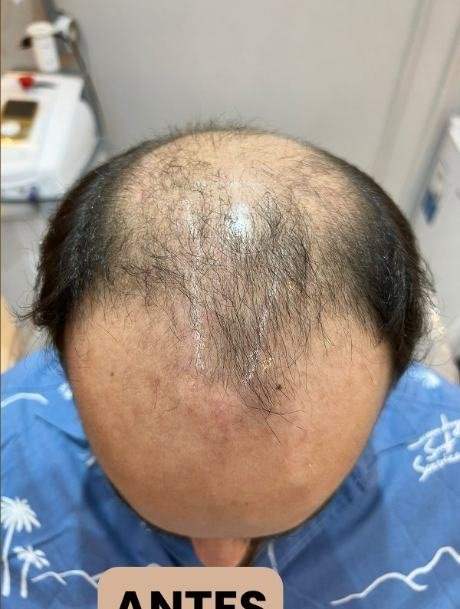 Antes do transplante capilar