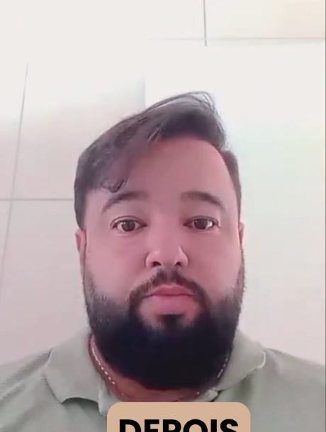 Depois do transplante capilar