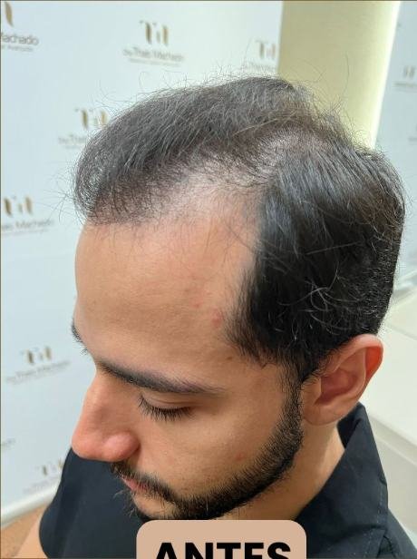 Antes do transplante capilar