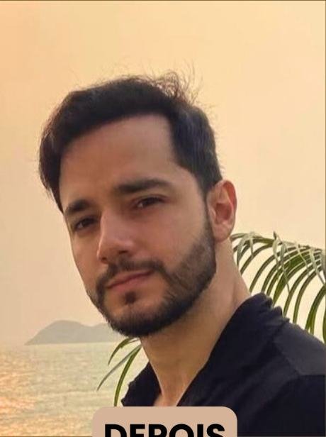 Depois do transplante capilar