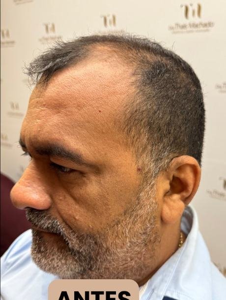 Antes do transplante capilar