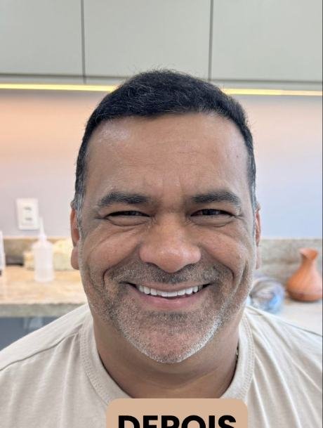 Depois do transplante capilar