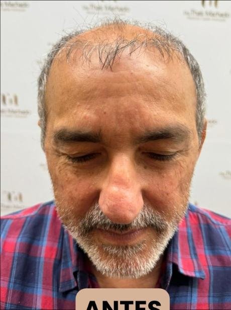 Antes do transplante capilar