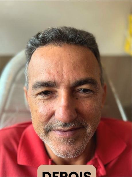 Depois do transplante capilar