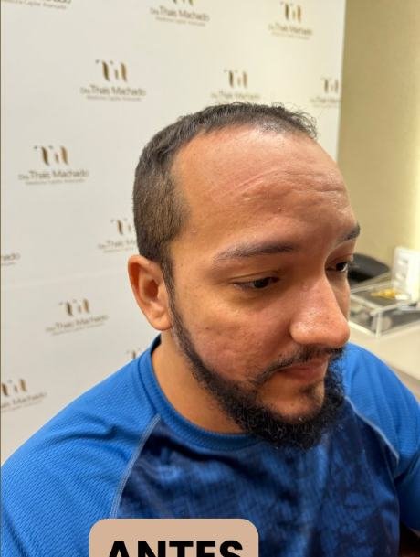 Antes do transplante capilar